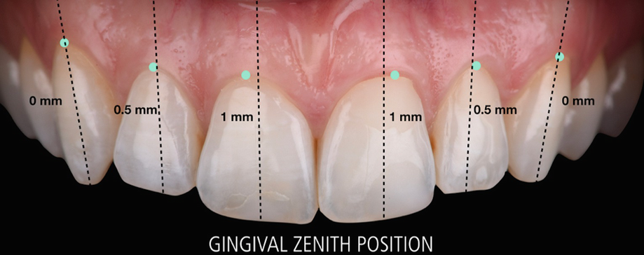 Gingival Component
