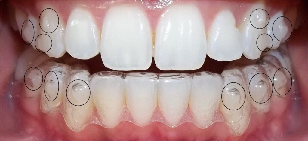 attachment on tooth surface