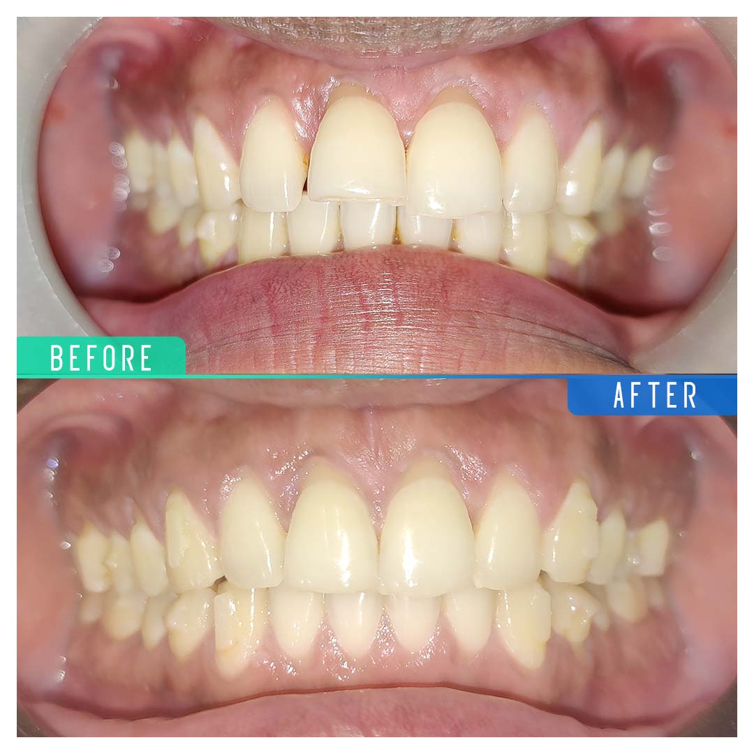 Invisible Clear Braces cost in India by Smile in Hour AHD, BOM