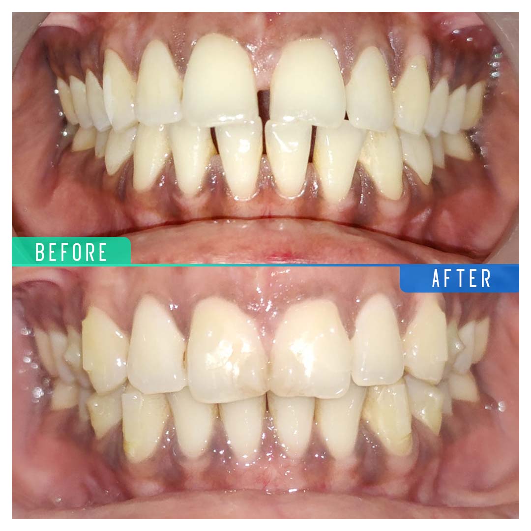 Clear Aligners Before And After In India