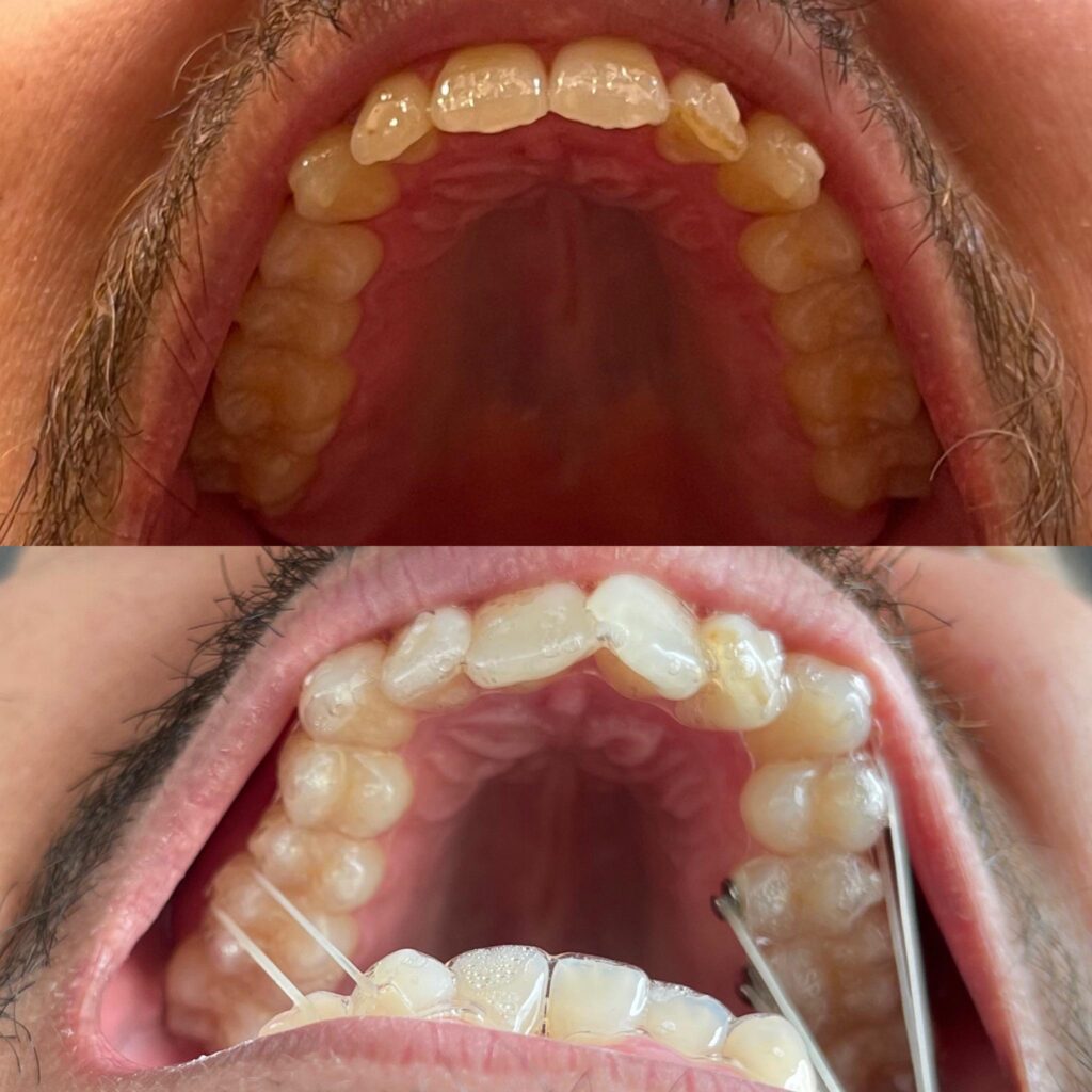 Adjuncts In Clear Aligner