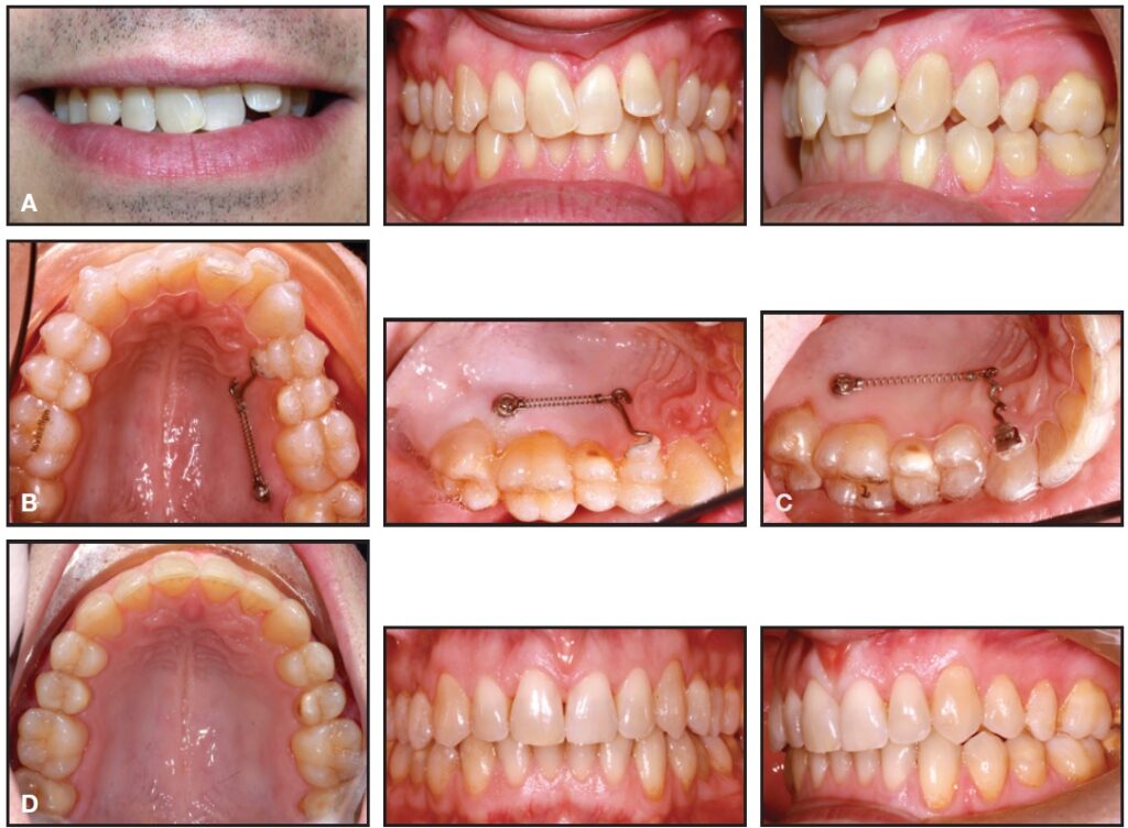 Adjuncts In Clear Aligner